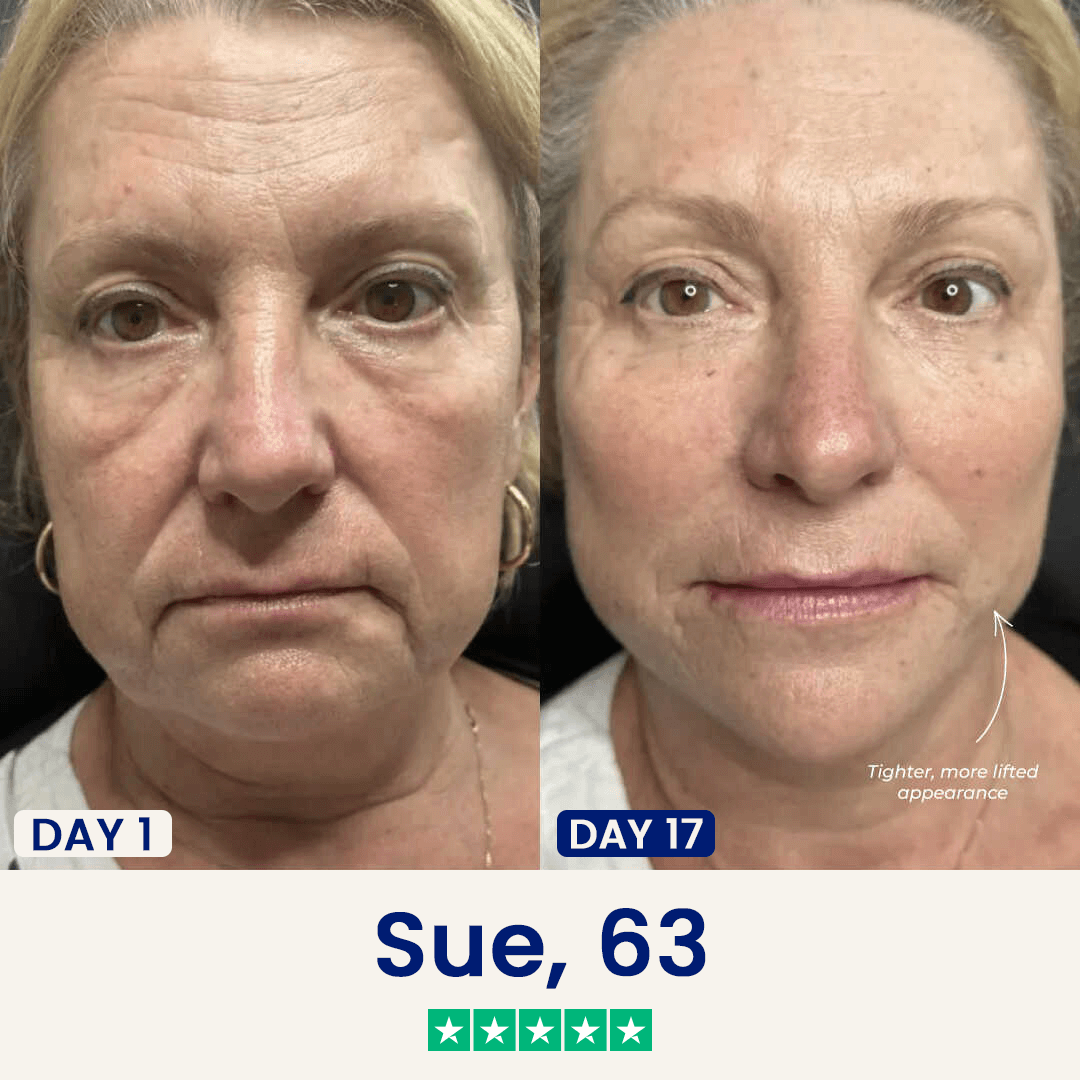 The Chinology™ Lift - Exclusive Halloween Deal